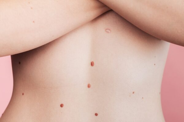 A woman's belly with numerous moles. The effect of the sun on the skin. Skin cancer. The panorama.