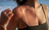 Rimedi Naturali per l'Eritema Solare