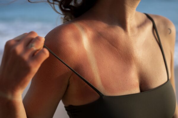 Rimedi Naturali per l'Eritema Solare