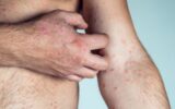 Cropped photo of half-naked man suffering from psoriasis scratching thick scaly clusters rash on ski