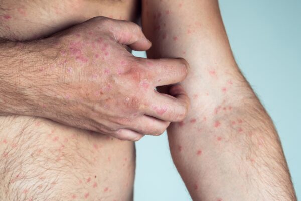 Cropped photo of half-naked man suffering from psoriasis scratching thick scaly clusters rash on ski